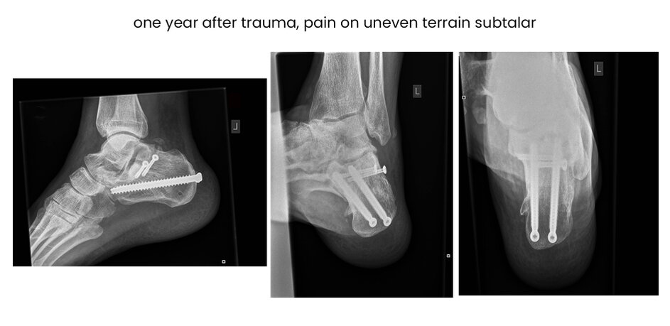 Cf Ce Minimal Invasive Treatment Of Calcaneal Fractures