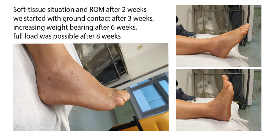 Calcaneal Fracture Minimal Invasive Treatment Of Calcaneal Fractures