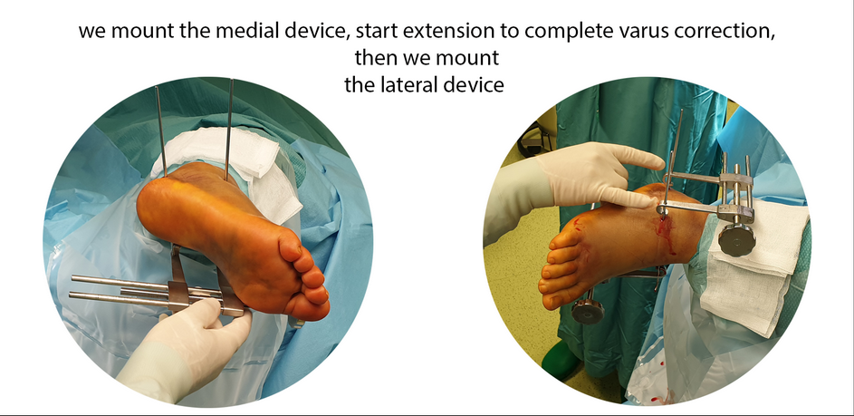 calcaneal fracture, - Minimal invasive treatment of calcaneal fractures